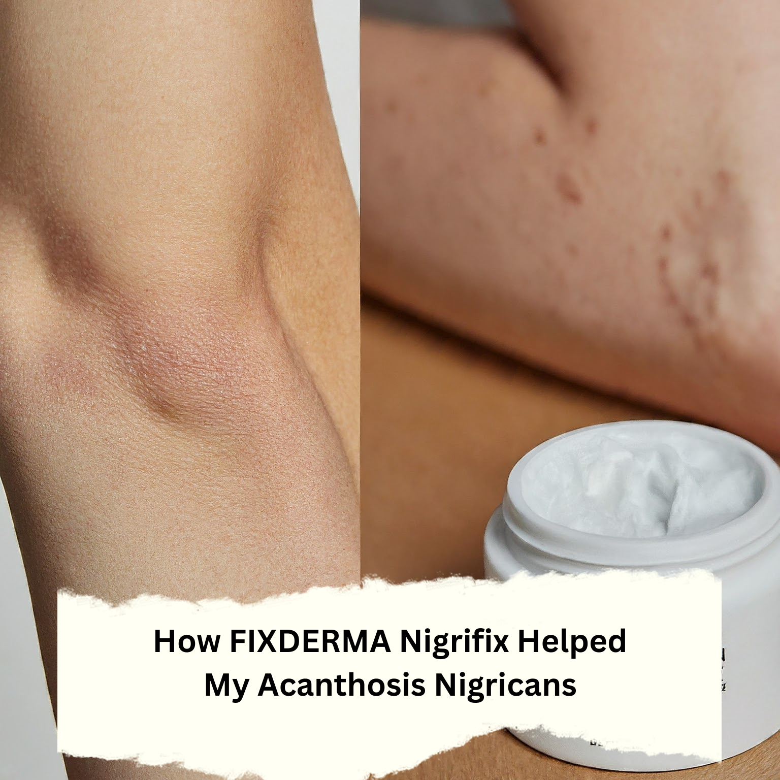 How FIXDERMA Nigrifix Helped My Acanthosis Nigricans