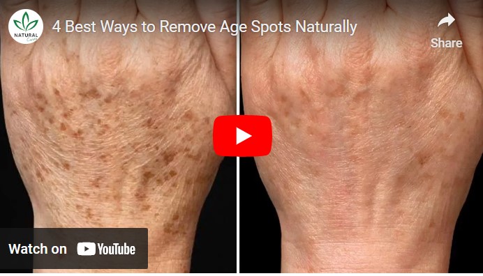 Age spots